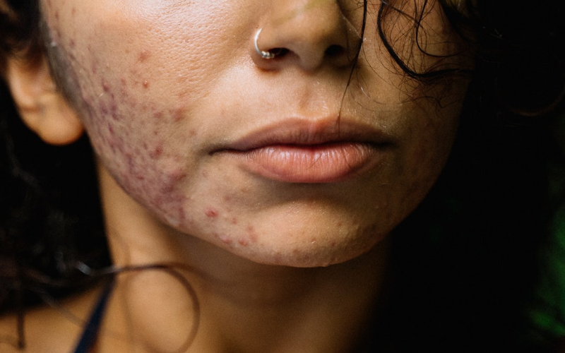 Read more about the article Does protein powder cause acne